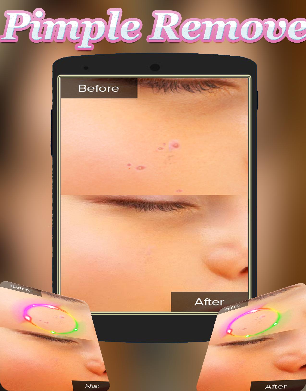 Face Blemishes Cleaner & Face Pimple Removal