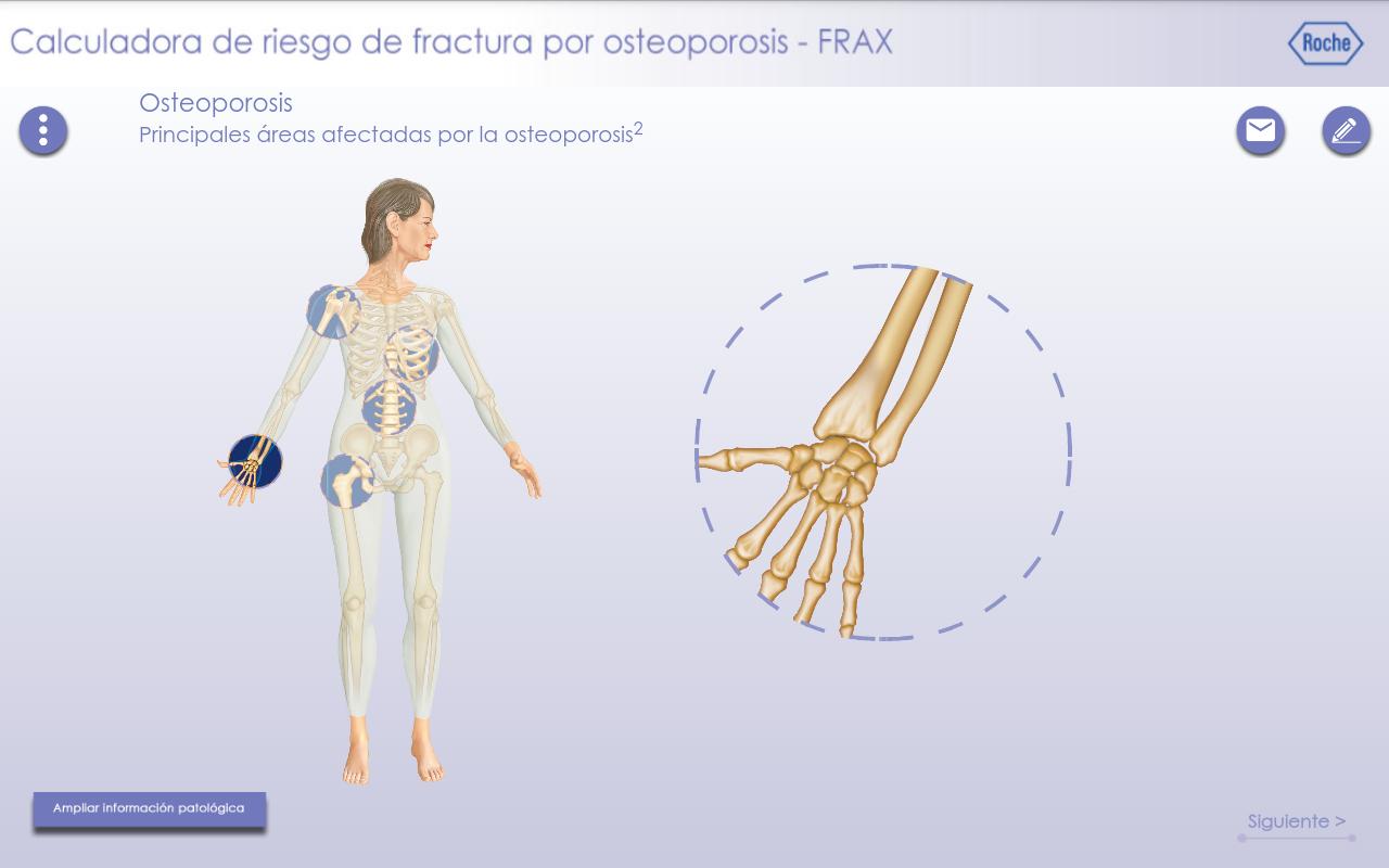 Calculadora FRAX Bonviva