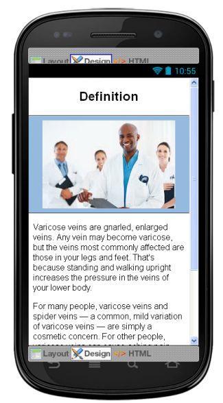 Varicose Veins Information
