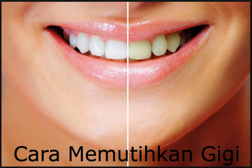 Tips Cara Memutihkan Gigi
