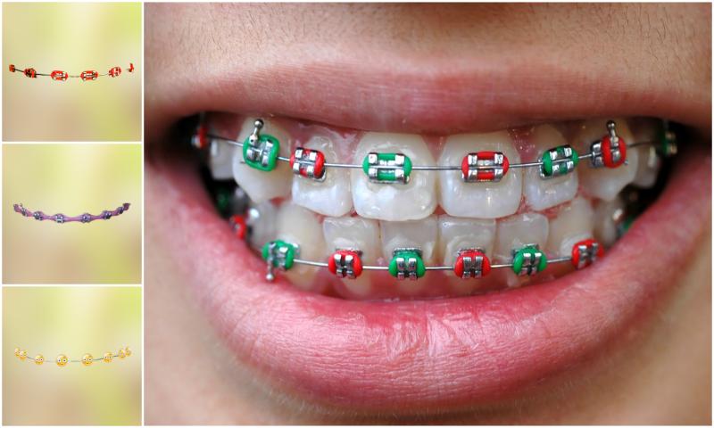 Real Teeth Braces Photo Maker