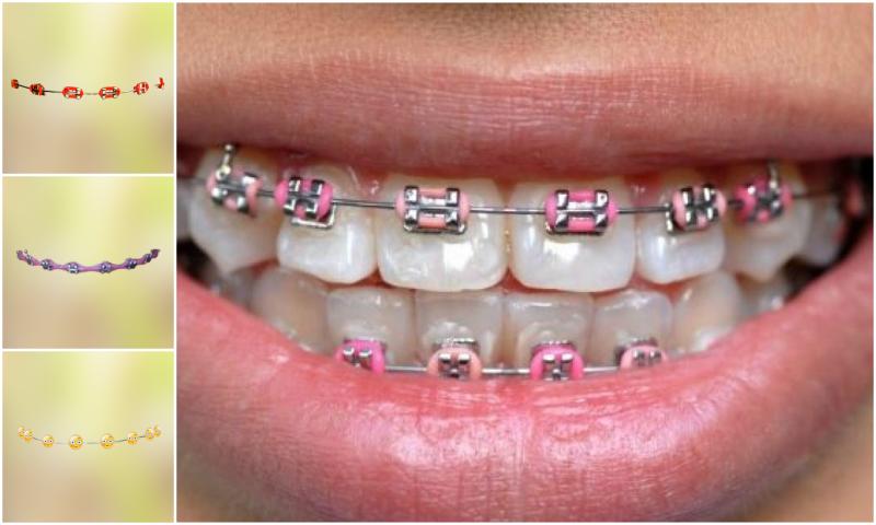 Real Teeth Braces Photo Maker