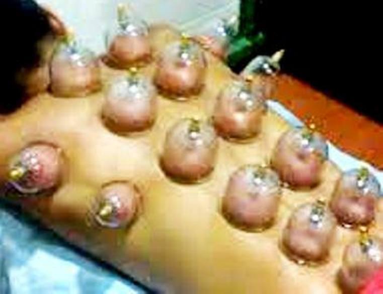 Cupping Therapy